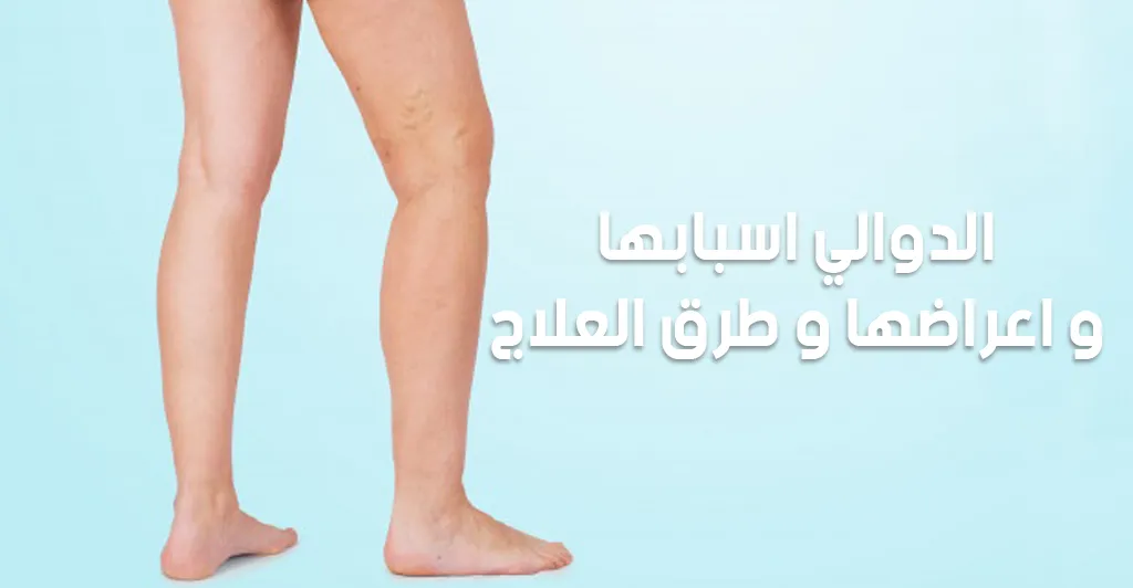 الدوالي : اسبابها و اعراضها و طرق العلاج